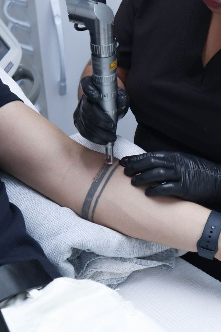 Détatouage par laser - Supremacy and Perfect